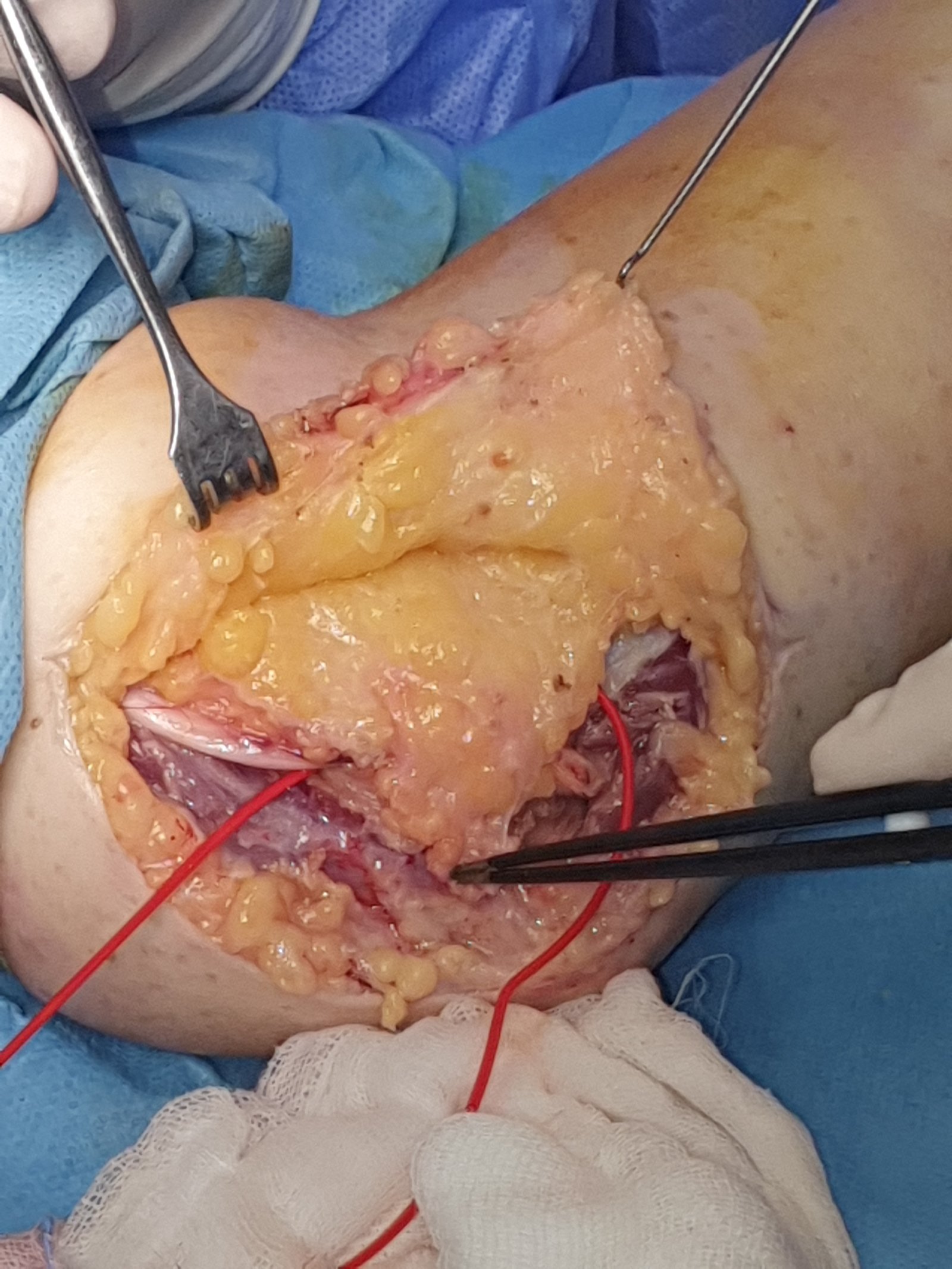 Compressione del nervo ulnare - FORMICOLIO IV E V DITO