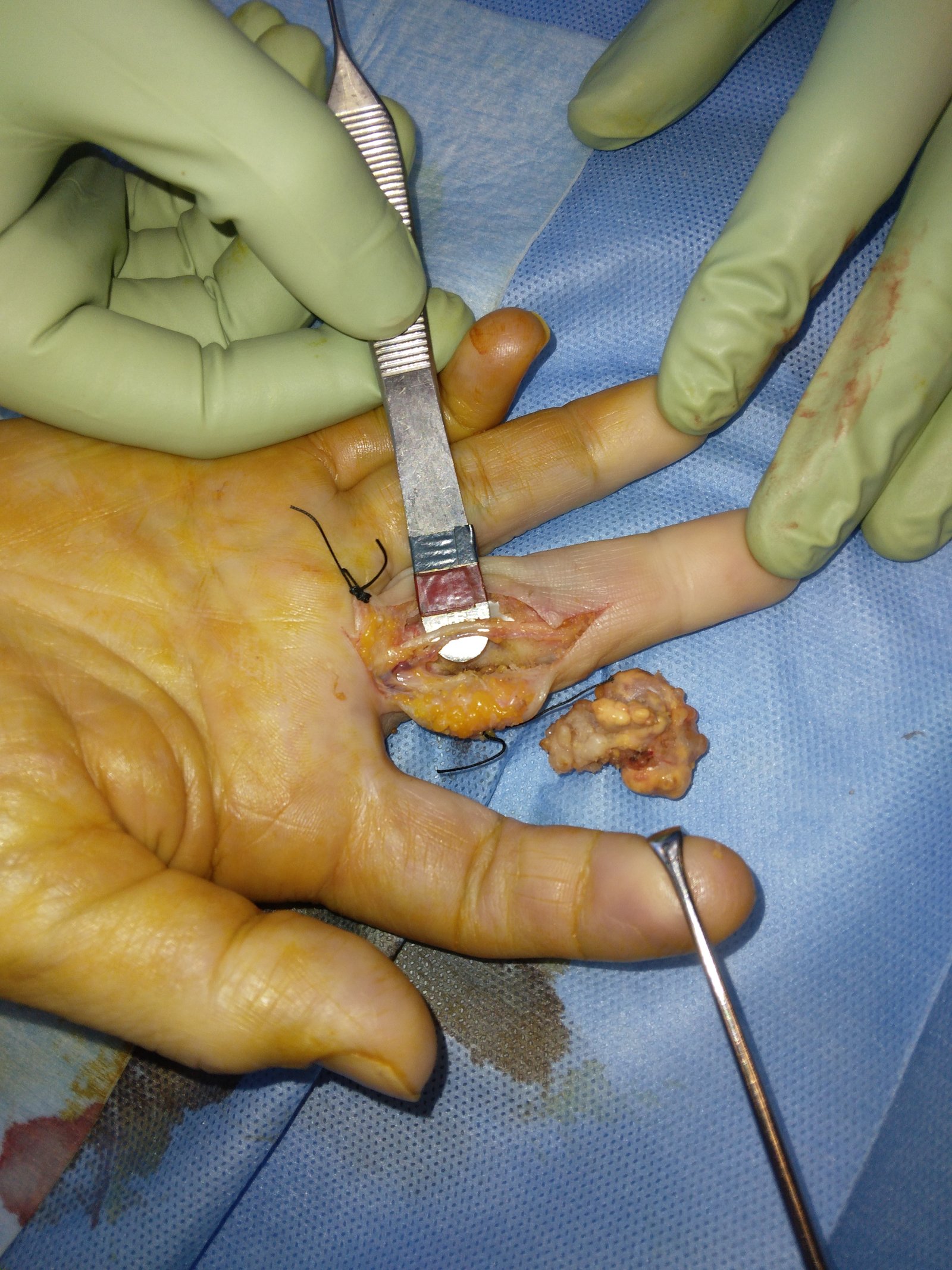 Tumore gigantocellulare (TGC)