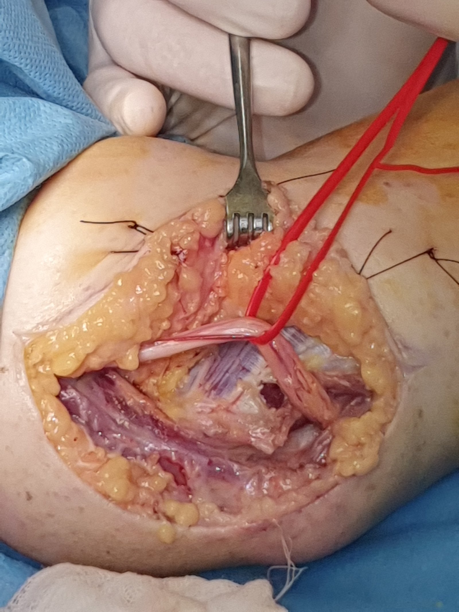 Compressione del nervo ulnare - FORMICOLIO IV E V DITO