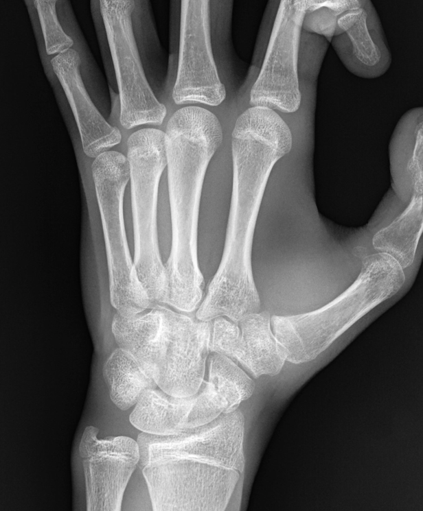 Pseudoartrosi dello scafoide