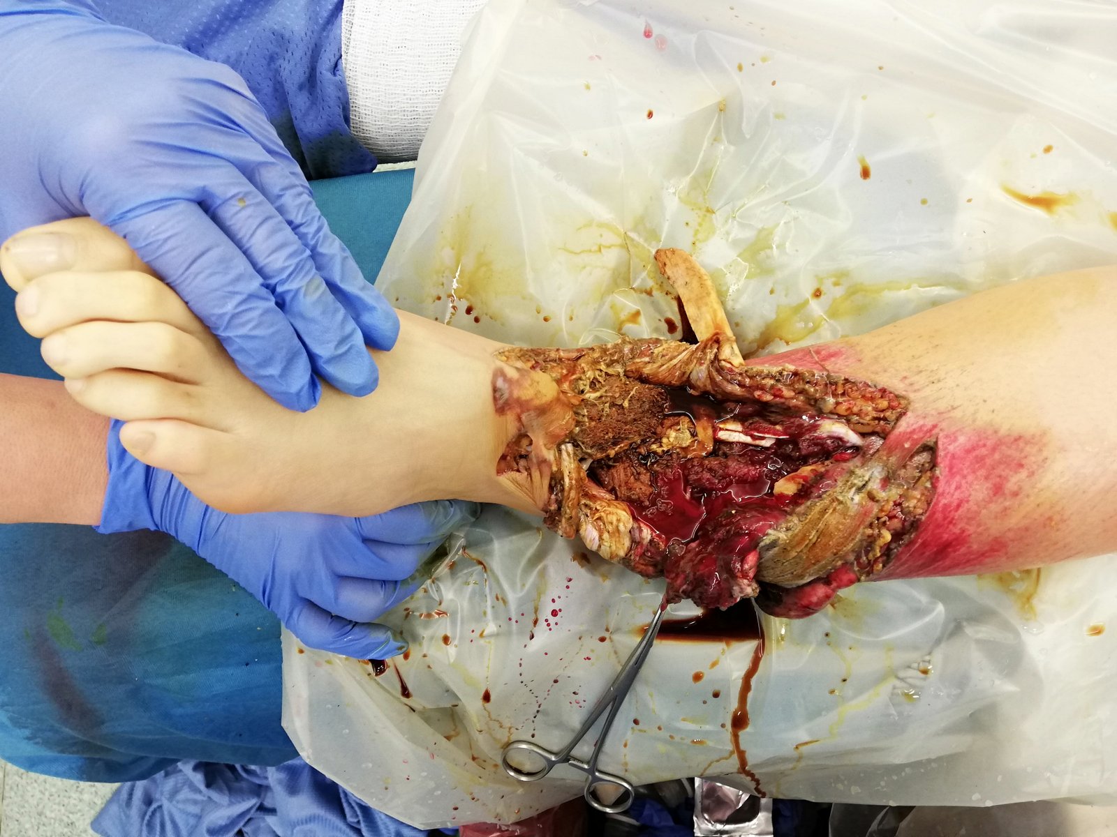 Ricostruzione arto inferiore - SALVARE LA GAMBA