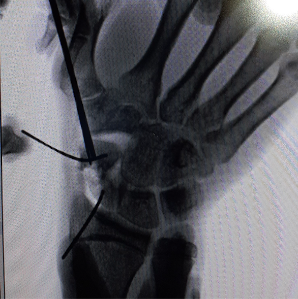 Pseudoartrosi dello scafoide