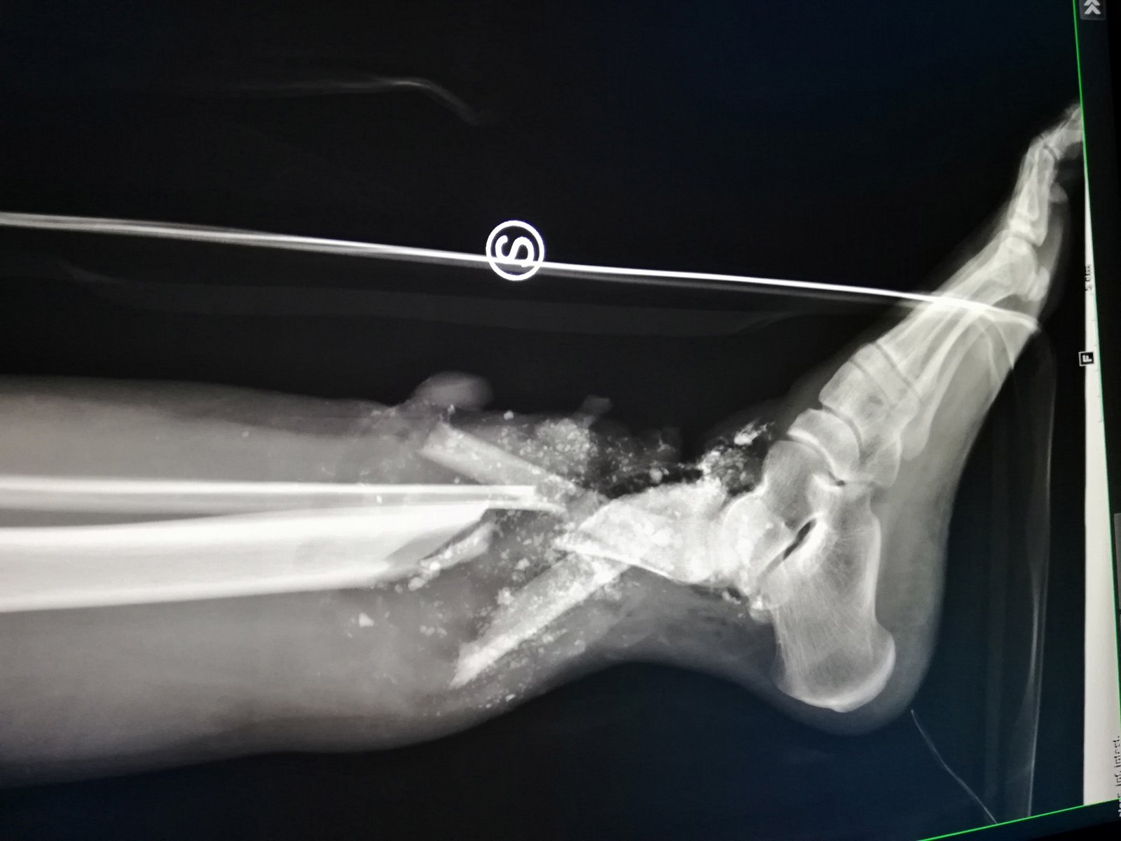 Ricostruzione arto inferiore - SALVARE LA GAMBA