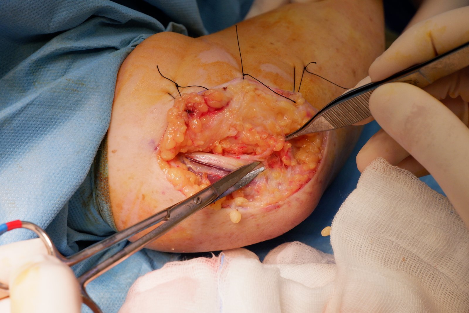 Compressione del nervo ulnare - FORMICOLIO IV E V DITO