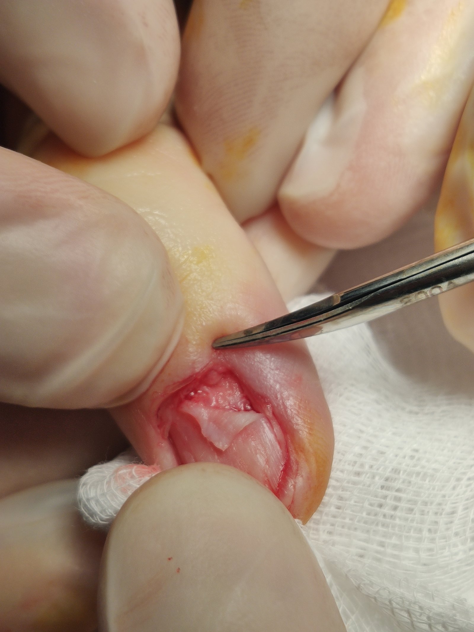 Tumore glomico delle dita