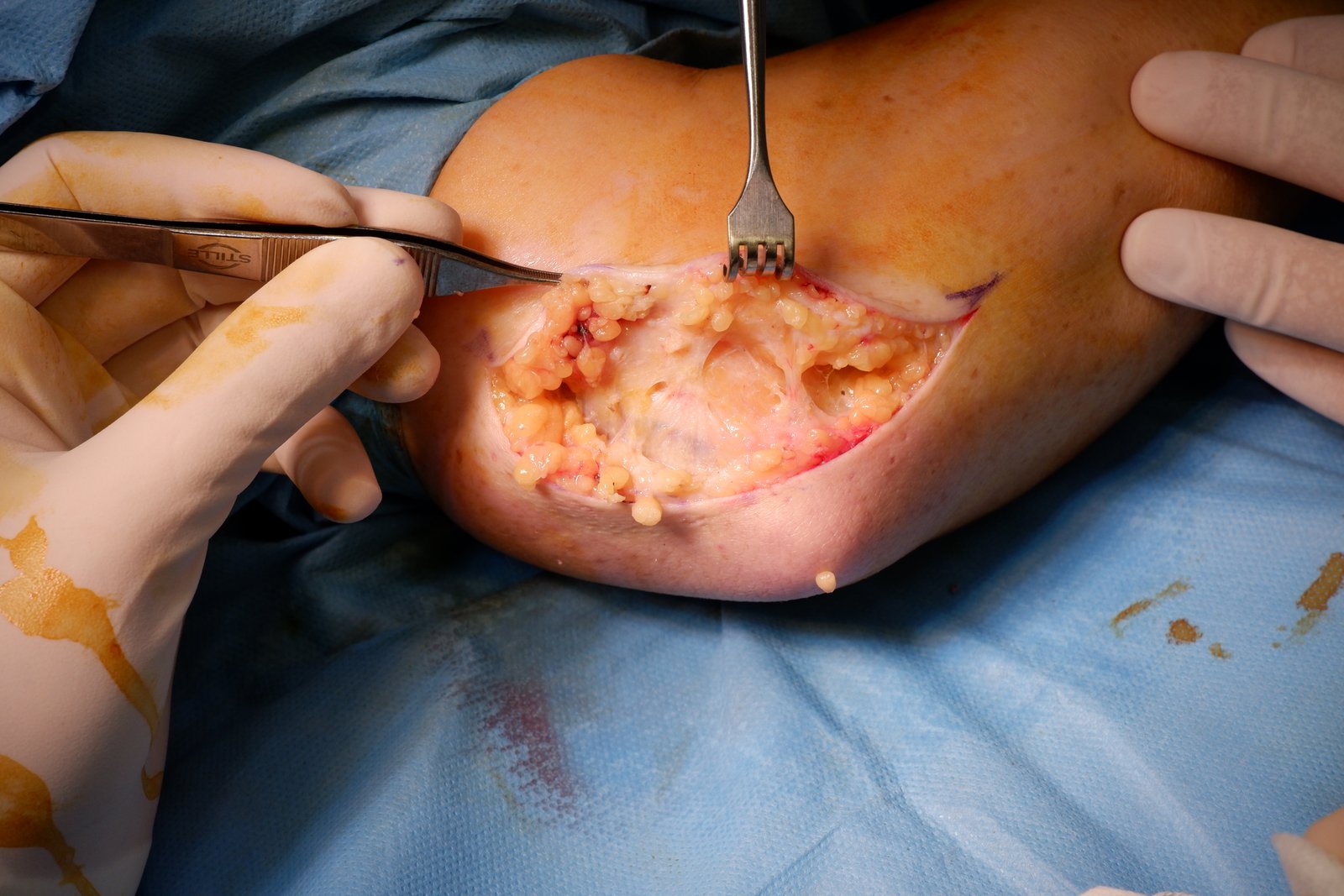 Compressione del nervo ulnare - FORMICOLIO IV E V DITO