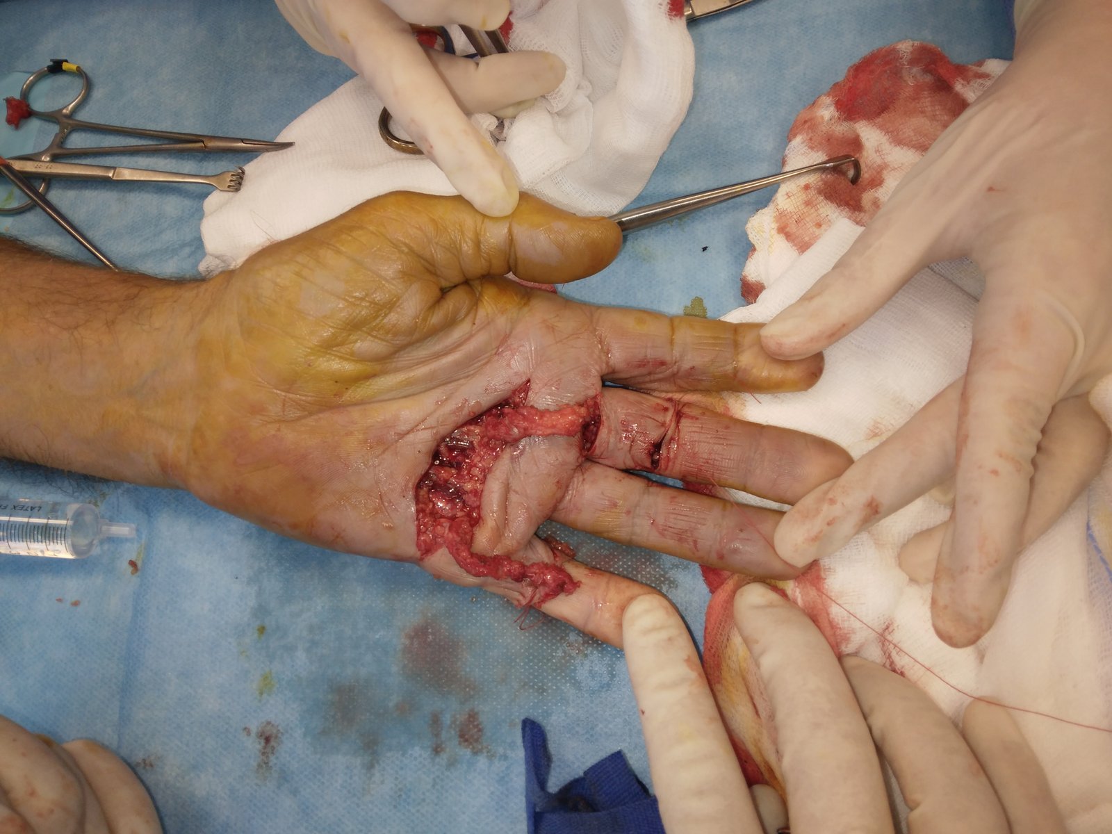 Morbo di Dupuytren - aponeurectomia minivasiva e cordotomia