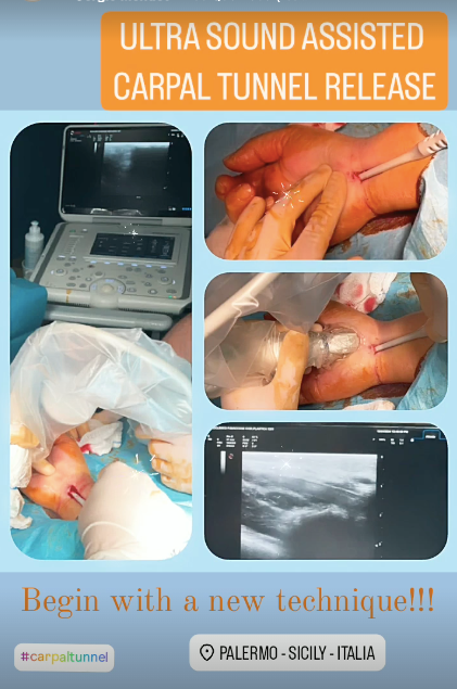 Sindrome del tunnel carpale - TRATTAMENTO ENDOSCOPICO/ECOGRAFICO MININVASIVO