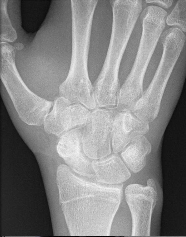 Pseudoartrosi dello scafoide